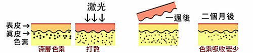 激光祛斑